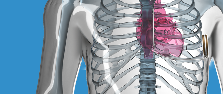 S-ICD vergeleken met andere apparaten S-ICD vergeleken met andere apparaten