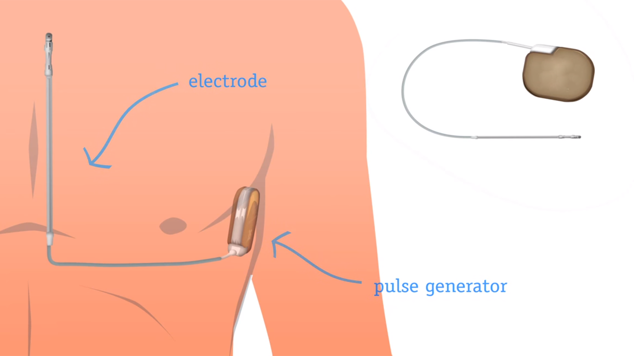 Subkutane ICD (S-ICD) implantatie Subkutane ICD (S-ICD) implantatie