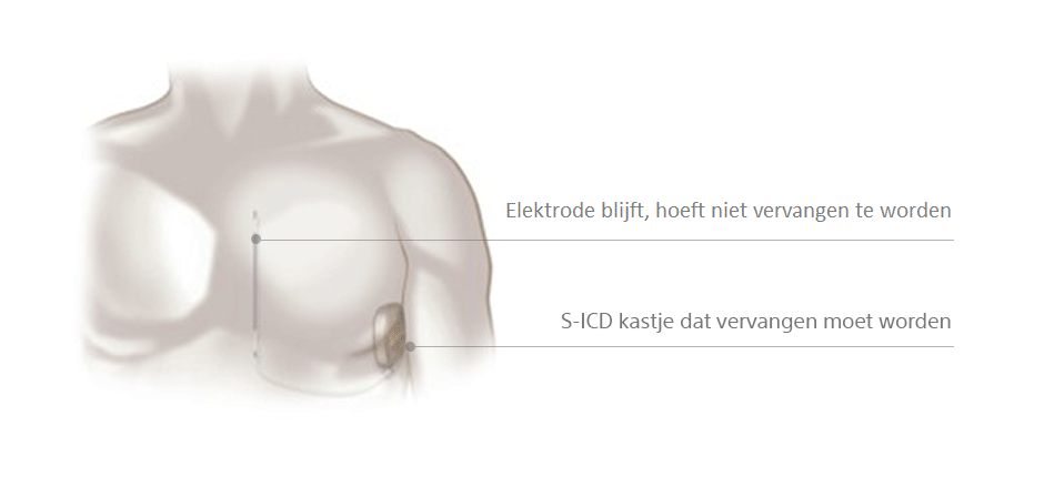 Procedure en herstel S-ICD wissel